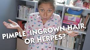 Warts can grow all over the body, but genital warts appear on the pubis, vagina, vulva, penis, or anus. Pimple Ingrown Hair Or Herpes Youtube