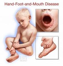 Cara atasi penyakit tangan kaki mulut hfmd. What Are The Best Ways To Treat A Toddler Who Has Hand Foot And Mouth Disease Does She Need To Be Seen By A Hand Foot And Mouth School Nutrition Kids Wellness