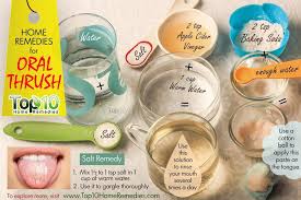 Home Remedies For Oral Thrush Top 10 Home Remedies Oral Thrush Remedies Remedies Oral Thrush Treatment