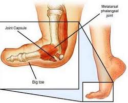 Turf toe is a sprain of the main joint of the big toe. How Can A Physical Therapist Help With Turf Toe Sports Physical Therapy Of New York