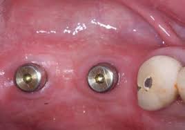 Dental coding with Kyle: D6010—Surgical placement of implant body:  Endosteal implant