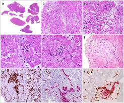 Myocarditis is an inflammatory disease of the myocardium, which is caused by different factors, such as infectious, immune, chemical, physical, and allergic ones. The Spectrum Of Myocarditis From Pathology To The Clinics Springerlink