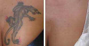 North houston laser tattoo removal's mission is to provide you with the best for all your tattoo removal needs. History Of Tattoo Removal North Houston Laser Tattoo Removal
