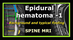 Epidural Hematoma 3 Typical And Atypical Finding Spine Mri Youtube