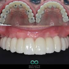 How much does it cost to get dentures? A Recap Of Some Of Our Full Arch Cases That Have Transformed So Many Patient S Lives