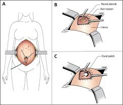 Les prévisions météo professionnelles pour north dam. Fetal Surgery For Open Spina Bifida In Canada Initial Results Sciencedirect