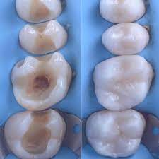 Placid Dental Implants Cost India Dentalimplants Dentalhygienistshirts Emergency Dentist Dentist Crafts Dental Fillings