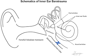 Image result for Inner Ear Decompression Sickness