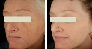 With tons of raving reviews on facebook and google, and trusted by 32,535 women in singapore, only aesthetics' ipl hair removal program is the local #1 . Intense Pulsed Light Lumecca Ipl Lakeshore Vein Aesthetics Clinic Pre Post Images Before After Photos