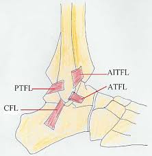 High Ankle Sprain Syndesmosis Injury Foot Ankle