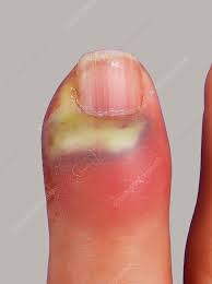 Image result for Paronychia feet