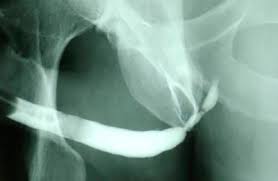 Image result for Retrograde Urethrogram