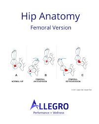 Image result for Femoral Retroversion