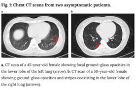 Nontobacco risk factors include environmental and occ … despite advances in our understanding of risk, development, immunologic control, and treatment options for lung cancer, it remains the leading. Covid 19 And Lung Cancer Previous Statements Lung Cancer Research Foundation
