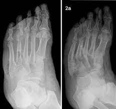 International multidisciplinary medical congress in albania 2020. Charcot Fuss Wikipedia