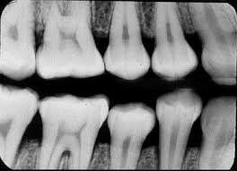 Dental Radiology Exam 2 Analysis Of Errors And Artifacts Flashcards Quizlet
