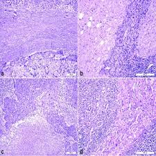 Hyperclinica medlife pdr vulturului brasov. S Georgescu S Research Works Spitalul Clinic Judetean De Urgente Sf Spiridon Iasi Iasi And Other Places