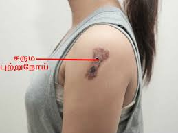 Cancer hone ke sanket कैंसर होता कैसे है? à®‡à®¨ à®¤ à®†à®± à®…à®± à®• à®± à®‡à®° à®¨ à®¤ à®•à®Ÿ à®Ÿ à®¯à®® à®‰à®™ à®•à®³ à®• à®• à®ª à®± à®± à®¨ à®¯ à®‡à®° à®• à®• à®© à®…à®° à®¤ à®¤à®® à®š à®• à®ªà®£ à®£ à®• à®• à®™ à®• 6 Signs You May Have Cancer Tamil Boldsky