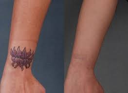 When you have got a tattoo you no longer want which can be unfortunate, you'll have to acquire a clinic for tattoo removal in little rock (arkansas) that can assist you to out. 1 Tattoo Removal Little Rock Best Tattoo Removal Little Rock