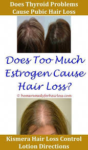 How To Know If My Hair Loss Is Normal Norwood Hair Loss Classification Chart Hair Loss Samson S Sec Stress Hair Loss Hair Loss Specialist Hair Loss In Children