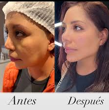 Harmonização Facial & Dermatología