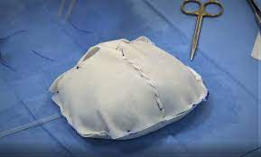 Brax, a social media influencer and rapper, has died at the age of 21. Indications And Pitfalls Of Prepectoral Breast Reconstruction With Braxon Acellular Dermal Matrix Adm A Preliminary Plastic Surgical Experience Journal Of Plastic Reconstructive Aesthetic Surgery