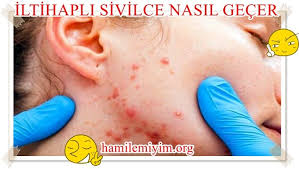 Koltuk üzerinde oluşmuş lekeleri çıkarma yöntemleri. Soru Iltihapli Sivilce Nasil Gecer Hamile Kadinlar Kulubu