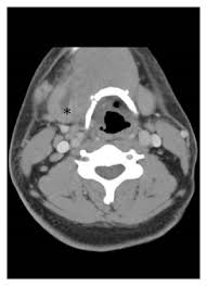 Your doctor has requested a computed tomography scan (ct or cat) of your abdomen. Predicting Neck Abscess With Contrast Enhanced Computed Tomography
