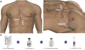 Automated external defibrillators (aeds) and implantable and wearable cardioverter defibrillators (icds and wcds) are devices that restore a normal heartbeat for people in sudden cardiac arrest. Tumescent Local Anesthesia Versus General Anesthesia For Subcutaneous Implantable Cardioverter Defibrillator Implantation Heart Rhythm