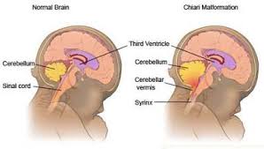 Cerebellum Google Search Espina Bifida Espinillas