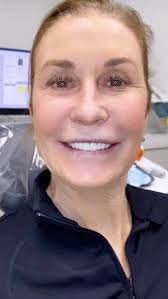 ❤️GUM LIFT+ 12 PORCELAIN VENEERS❤️, BEAUTIFUL AND NATURAL RESULTS, 2 VISITS  ONLY, ., smileobsession.com, #smile #porcelain #pocelainveneers  #smilemakeover #hollywood #hollywoodsmile #chicago ...