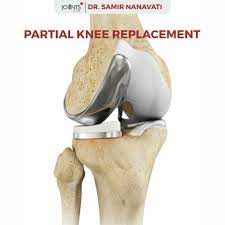 Dr. Samir Nanavati (Life Care Institute Of Medical Science & Research) in  Naranpura Vistar,Ahmedabad - Best Joint Replacement Surgery Doctors in  Ahmedabad - Justdial