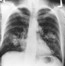 Image result for lung cancer xray
