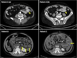 Image result for Neutropenic Colitis