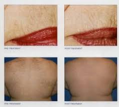 Reviews of the best at home laser hair removal machines 2020. Laser Hair Removal Port St Lucie