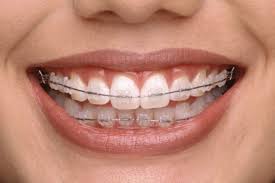 Check spelling or type a new query. General Dentistry Braces Clinic Free Consultations