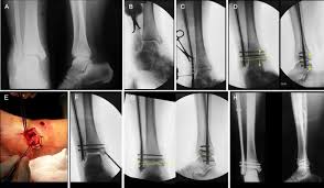 They can also be tender to the touch, and in some cases they can make walking or putting any weight on the affected foot very difficult and painful. Nailing The Fibula Alternative Or Standard Treatment For Lateral Malleolar Fracture Fixation A Broken Paradigm Springerlink