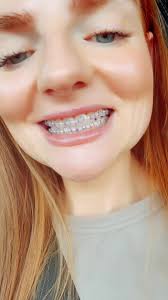 Violet Braces Color