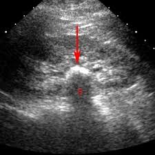 Emergency Ultrasound