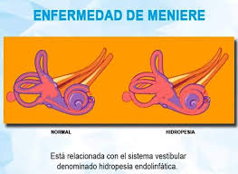 La sindrome di ménière è una malattia che affligge l'orecchio interno. Facebook