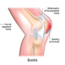 Image result for Bursitis