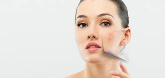 Lazerle Sivilce Akne Tedavisi Seanslari 2020 Fiyatlari