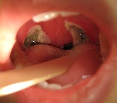 For some, they are not much of a problem at all, but for others, they can be very. Tonsillectomy Wikipedia