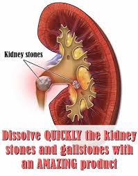 Dissolve Quickly The Kidney Stones And Gallstones With An Amazing Product Kidney Stones Gallstones Kidney Stones Remedy