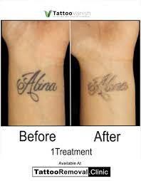 2 years ago 2 years ago tattoo removal tattoo removal facts, tattoo removal questions tattoos have been a synonym for permanent for quite a while. Tattoo Vanish Removal Method