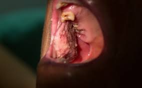 Image result for dental cancer