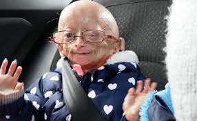 Adalia Rose Bio Is She Dead Or Alive Here Are The Facts Networth Height Salary