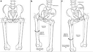 Image result for True Leg Length Discrepancy