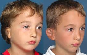 Microtia Is The Condition In Which The External Part Of The Ear Also Known As Pinna Is Underdeveloped Microtia Plastic Surgery Surgery Reconstructive Surgery
