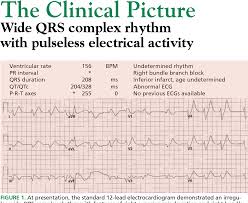 Image result for Pulseless Electrical Activity